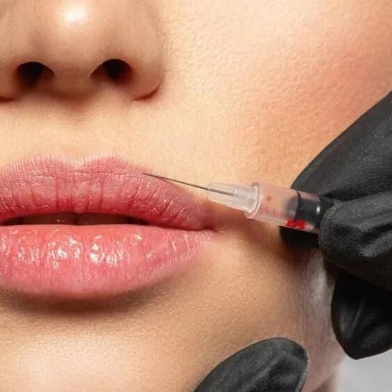 FILLERS O MATERIALES DE RELLENO