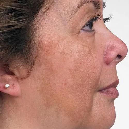 MANCHAS SOLARES-MELASMA