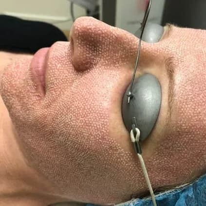 REJUVENECIMIENTO FACIAL CON LÁSER CO2 FRACCIONADO