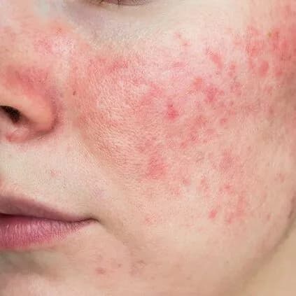 ROSACEA